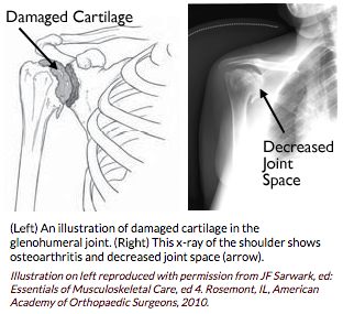 Shoulder Arthritis - Damaged Cartilage