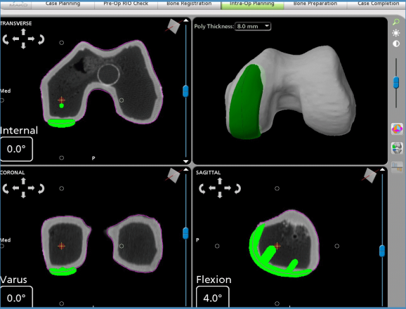 Orthopedic Physician Associates First Practice in PNW Offering Robotically Assisted Total Knee Replacement