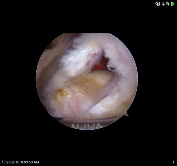 Dr. Kevin Ko: What You Need to Know About Rotator Cuff Tears