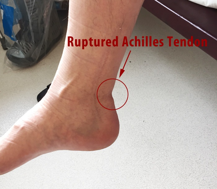 Ruptured Achilles Tendon