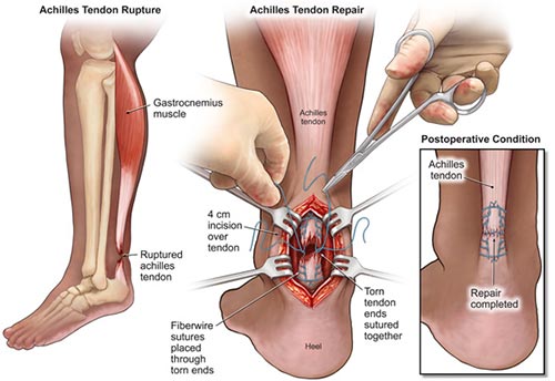 Acute Achilles Tendon Repair