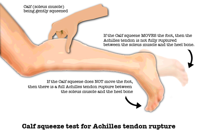 Acute Achilles Tendon Ruptures