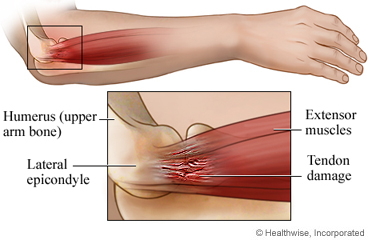 Your Guide To Muscle Strains & How To Treat Them