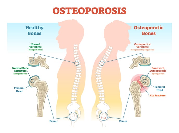 best treatment for osteoporosis