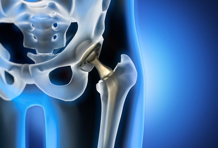 Hip conditions treatment Poulsbo