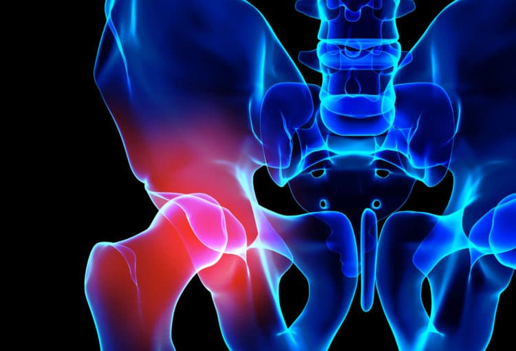 3D illustration of hip painful skeleton x-ray