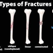 Types of Bone Fractures