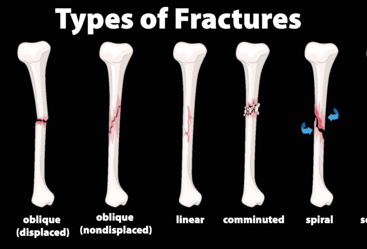 Bone Fracture Types