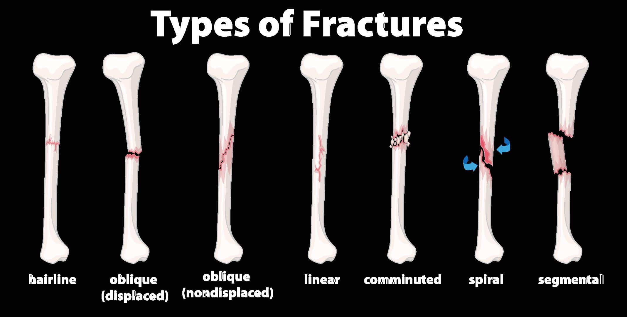Types of Bone Fractures