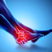 What is the Recovery Time for Sprained Ankle