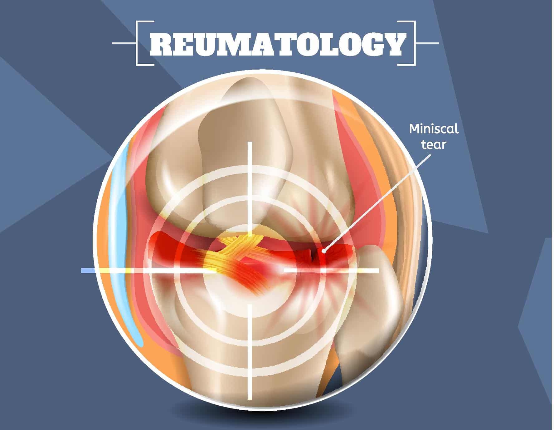 What is Medial Meniscus Tear?