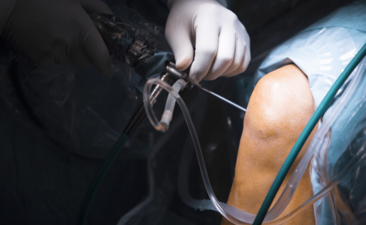 knee arthroscopy